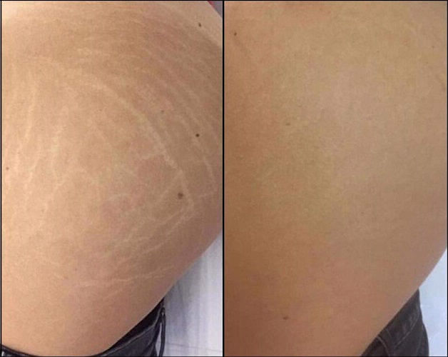 Camuflagem de estrias na Barra da Tijuca RJ