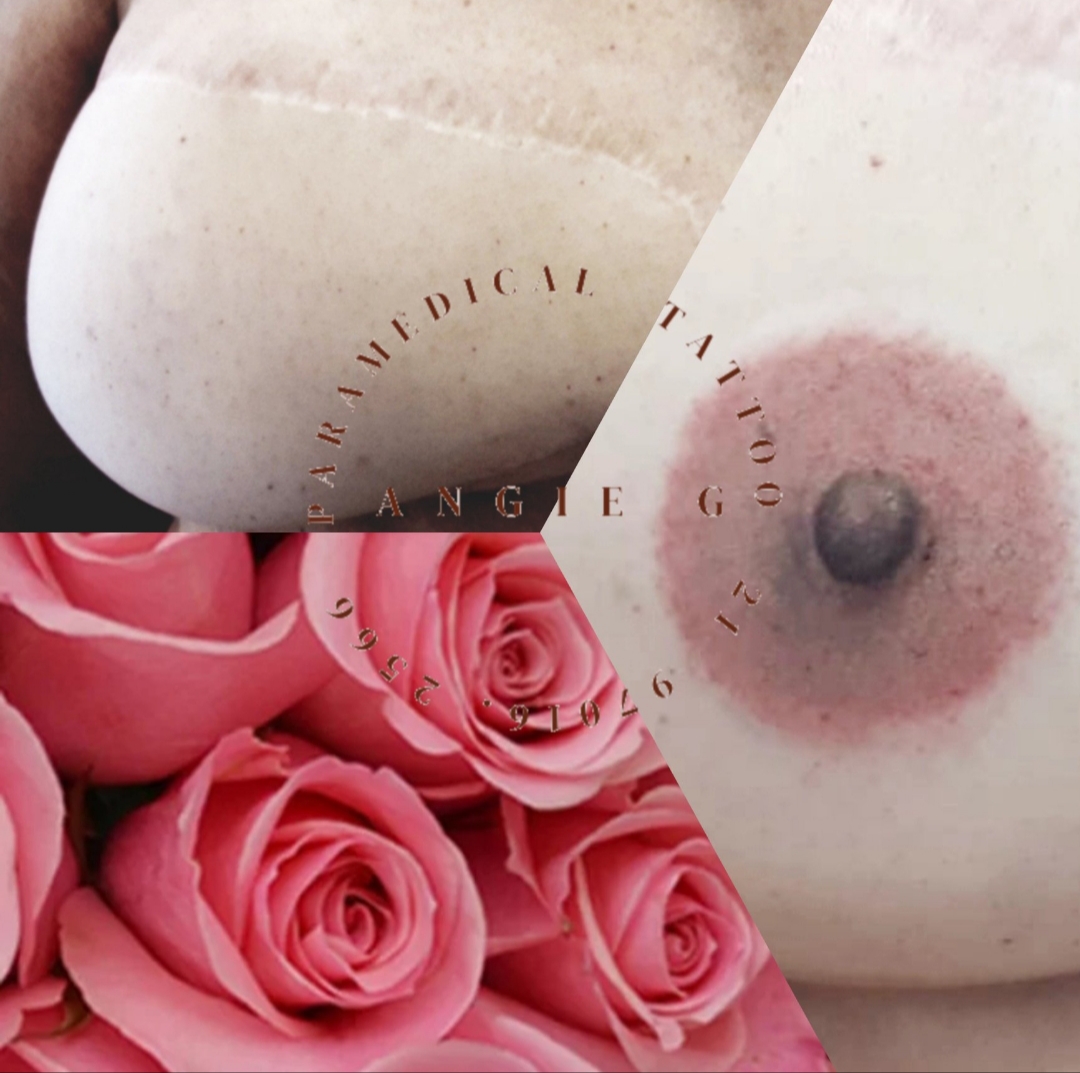 Especialista em reconstrução de aréolas na Barra da Tijuca RJ