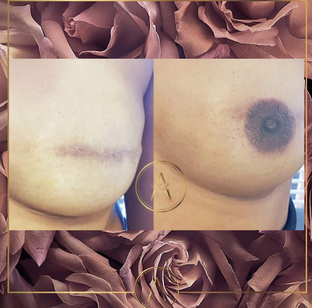 Especialista em reconstrução de aréolas na Barra da Tijuca RJ