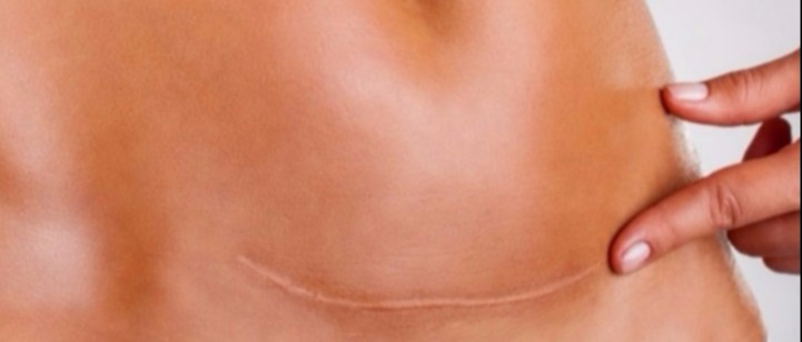  Especialista em Camuflagem de Cicatriz na Barra da Tijuca