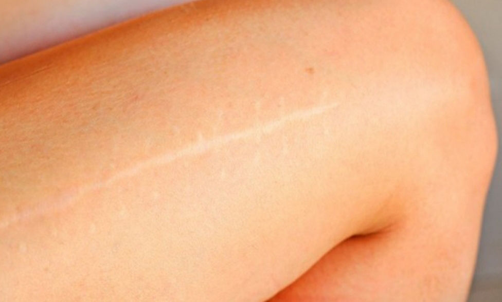  Especialista em Camuflagem de Cicatriz na Barra da Tijuca